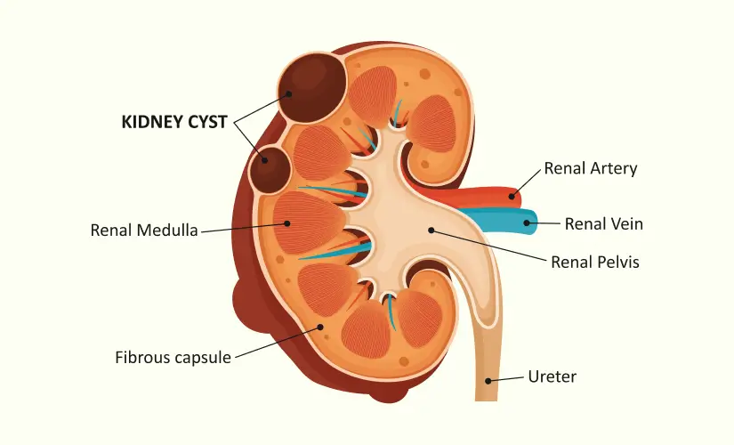 Renal Cyst